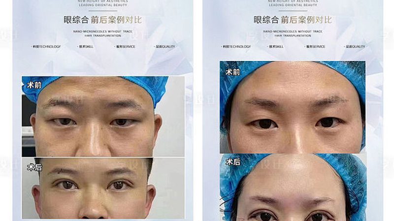长沙医美术后护理步骤