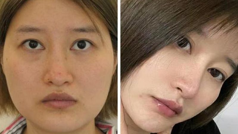 注射美容：哪些年龄群体需谨慎选择？**
