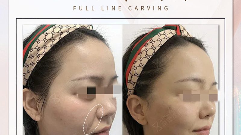 注射美容价格与效果对比