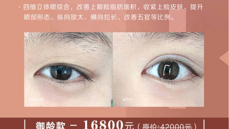 全切双眼皮与埋线双眼皮：持久度大揭秘**