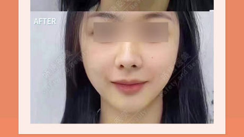 轻医美项目，年龄段的精准匹配之道