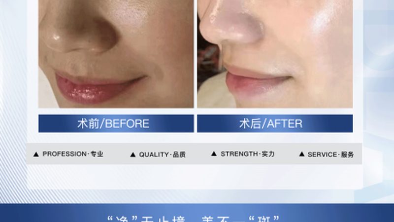 激光祛斑加盟店投资预算：揭秘加盟背后的关键因素