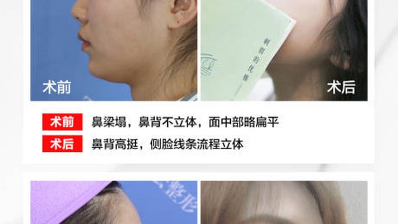 小标题：注射美容与线雕的区别