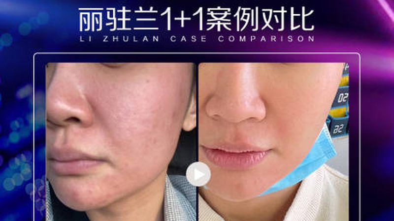 光子嫩肤家用仪器怎么选