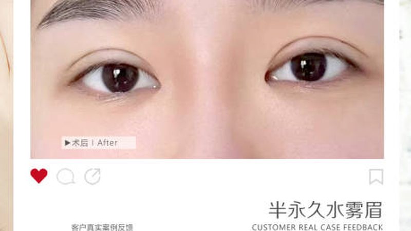 玻尿酸隆鼻后多久戴眼镜？揭秘恢复期注意事项**