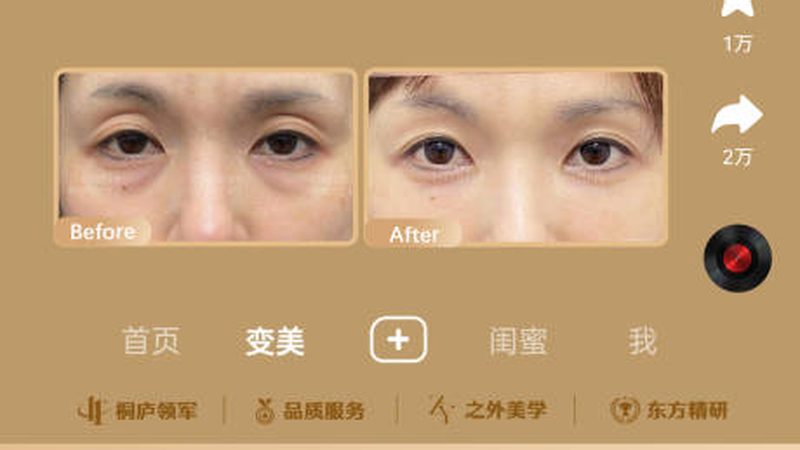 玻尿酸注射后，你不得不知的护理流程