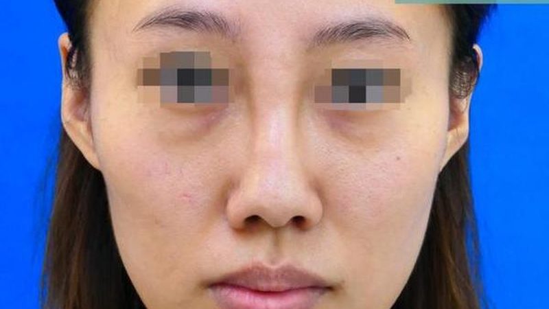 小标题：术后消肿的重要性